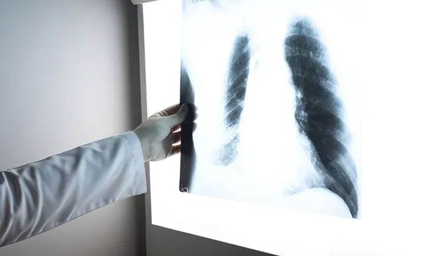 Tütün kullanımı akciğer kanseri riskini 20 kata kadar artırıyor