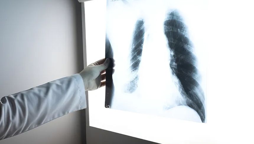 Tütün kullanımı akciğer kanseri riskini 20 kata kadar artırıyor